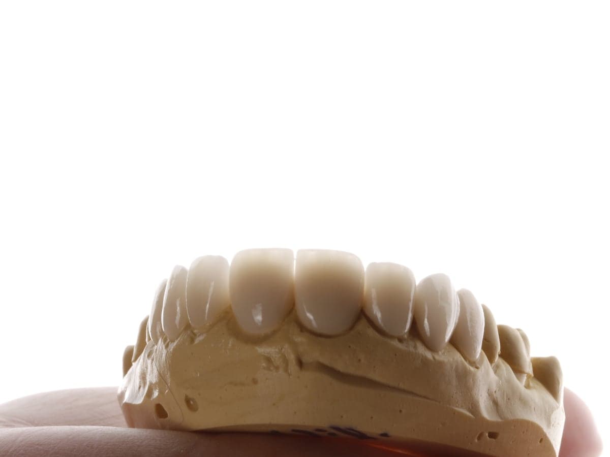 Lab model with the veneer design in place