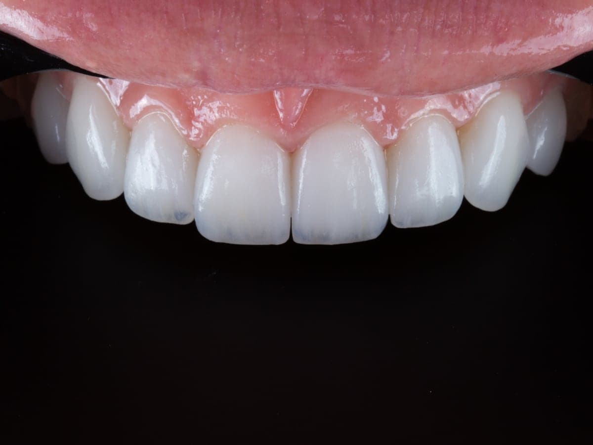 Close-up of the veneers in place